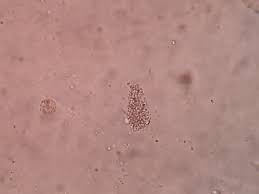 Protein in urine
