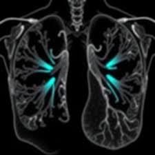Symptoms of lung cancer